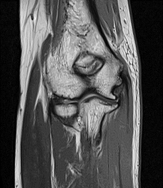 肘関節MRI